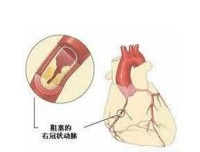 得了冠心病真的可以吃中药治好吗图4