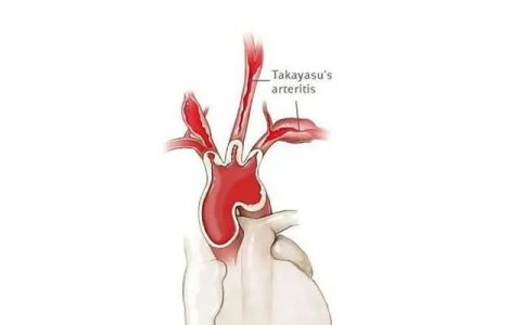 杏林微科普脉管炎