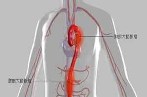 「杏林微科普」大动脉炎你了解么？