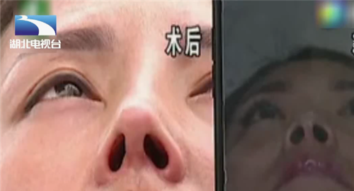 女子花3万整形，鼻子歪了鼻孔一大一小，老公：人不像人鬼不像鬼