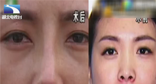 女子花3万整形，鼻子歪了鼻孔一大一小，老公：人不像人鬼不像鬼