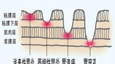 慢性浅表性胃窦炎饮食要注意什么图4