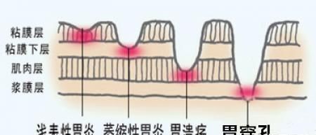 慢性浅表性胃窦炎饮食要注意什么图5