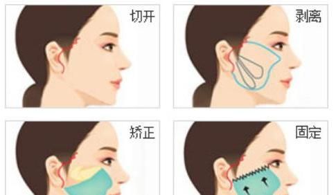 北大整形教授张宗学丨揭秘神奇的小拉皮手术