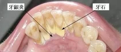 每天刷牙，为什么牙齿上还是会附着牙结石？