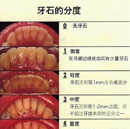 每天刷牙，为什么牙齿上还是会附着牙结石？