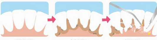 每天刷牙，为什么牙齿上还是会附着牙结石？
