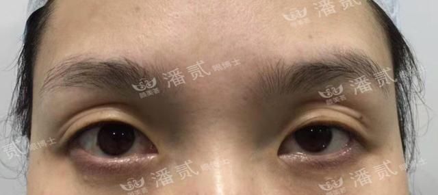 眼综合：眼窝凹陷+上睑下垂+三眼皮＝难做的眼部整形案例
