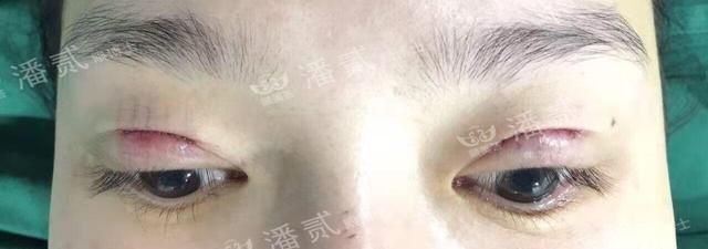 眼综合：眼窝凹陷+上睑下垂+三眼皮＝难做的眼部整形案例