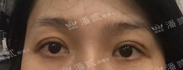 眼综合：眼窝凹陷+上睑下垂+三眼皮＝难做的眼部整形案例