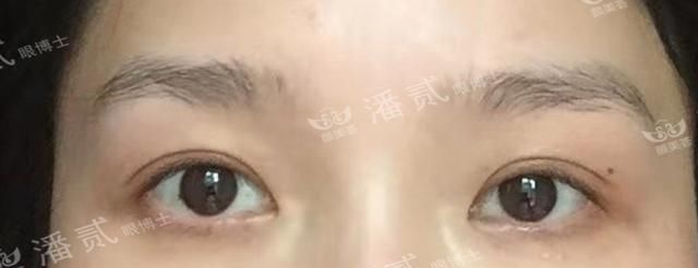 眼综合：眼窝凹陷+上睑下垂+三眼皮＝难做的眼部整形案例