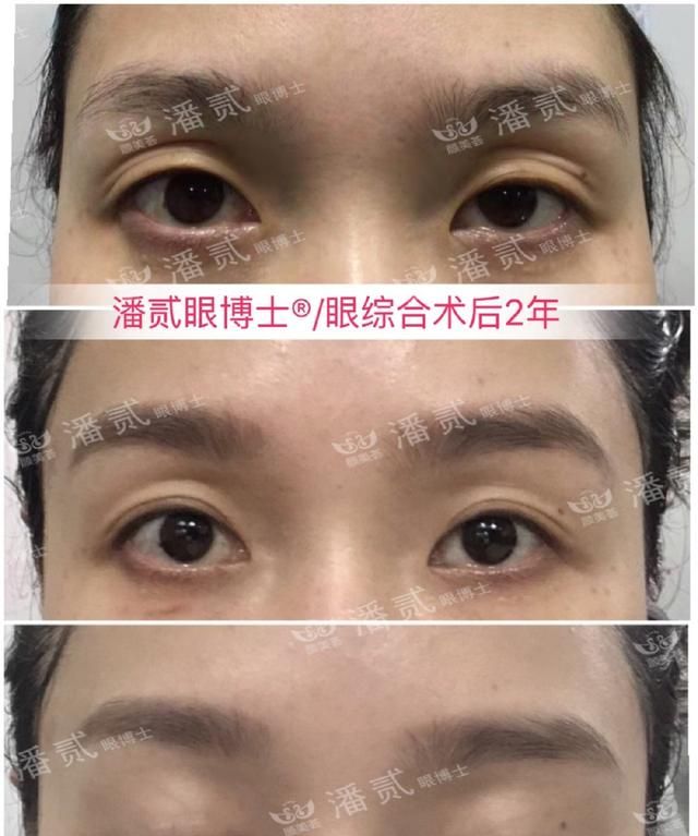 眼综合：眼窝凹陷+上睑下垂+三眼皮＝难做的眼部整形案例