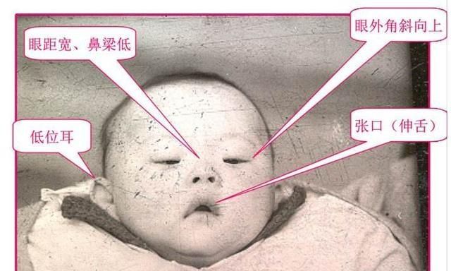 怀孕唐筛和无创羊穿做哪个比较好图3