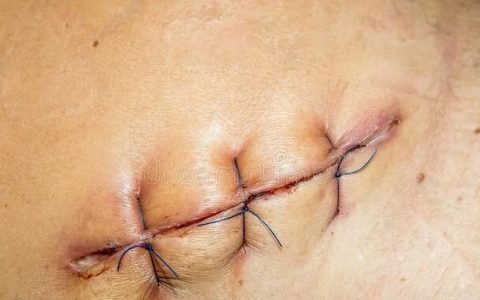 顽固疤痕5种方法祛疤并帮助愈合