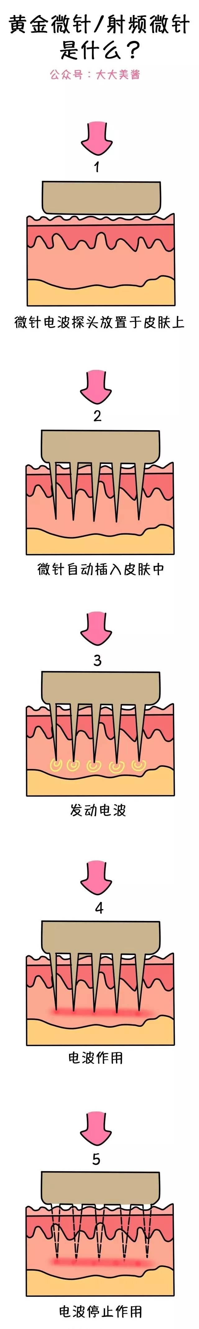 美肤项目科普篇｜微针，全能美容小能手