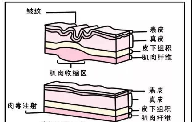 针对眉间去皱纹，分享一个非常简单的去皱纹方法