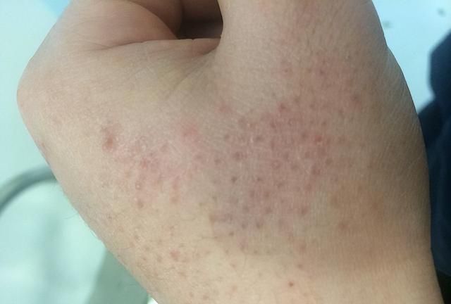艾滋病的皮肤表现是什么？自查身体有没有这5种症状