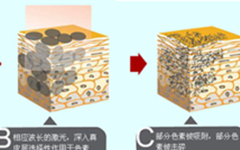 皮肤美容激光科主任韩昱华：为什么单纯激光祛斑效果不好？