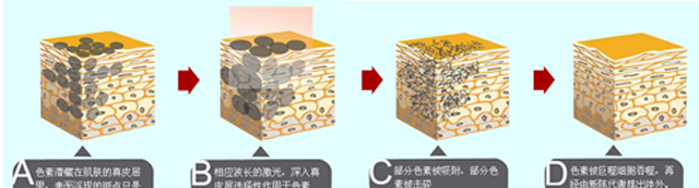 皮肤美容激光科主任韩昱华：为什么单纯激光祛斑效果不好？