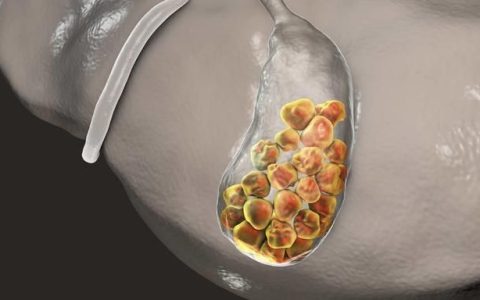 吃什么可以帮助溶解胆结石,有利于排石呢