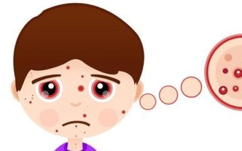 预防痘痘反复发作做好这4个方面