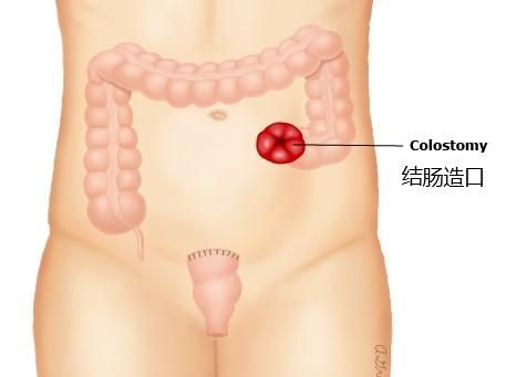 便便改道手术：从肚皮上的人造肛门拉粑粑