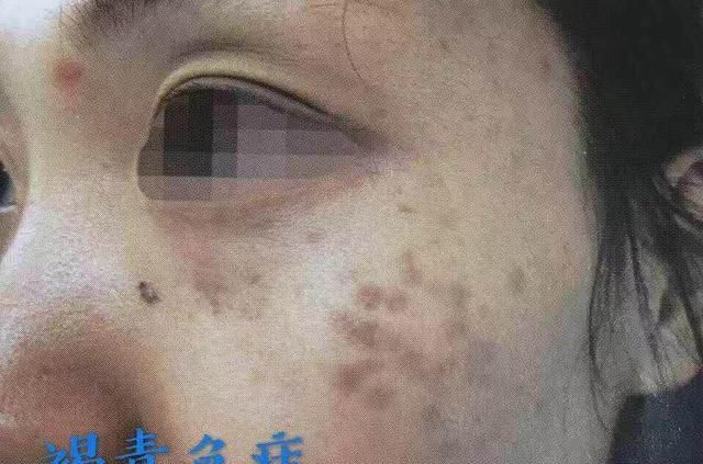 这种面部色斑好发于20岁以上成年人，治疗它需要1年半的时间