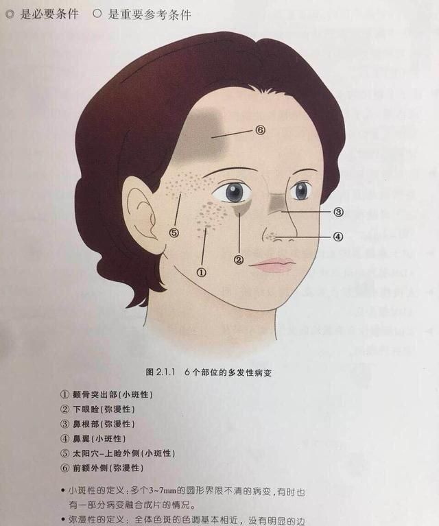 这种面部色斑好发于20岁以上成年人，治疗它需要1年半的时间