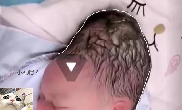 “黑脸宝宝”被亲妈嫌弃，护士却夸好看，2个月后高颜值逆袭