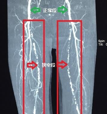 “腿疼”到底是什么引起的，很多医生都不知道