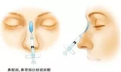 玻尿酸有什么用处图4