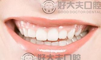 为什么要用“美容冠”美齿术