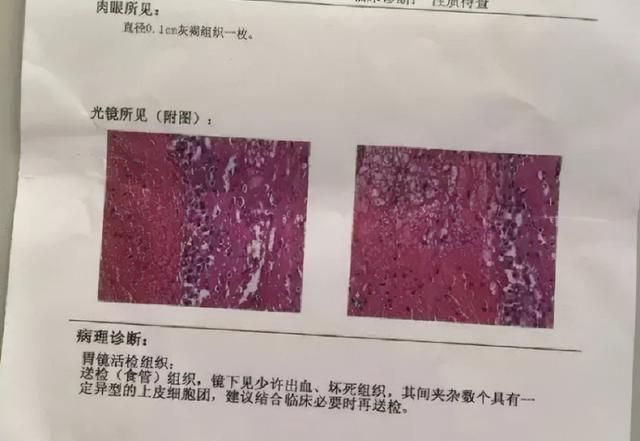 服用阿司匹林注意这三点，可减少胃部不适症状，快看你吃对了吗？