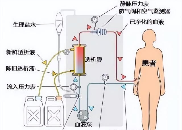 什么是血液透析？血透的工作原理是什么？