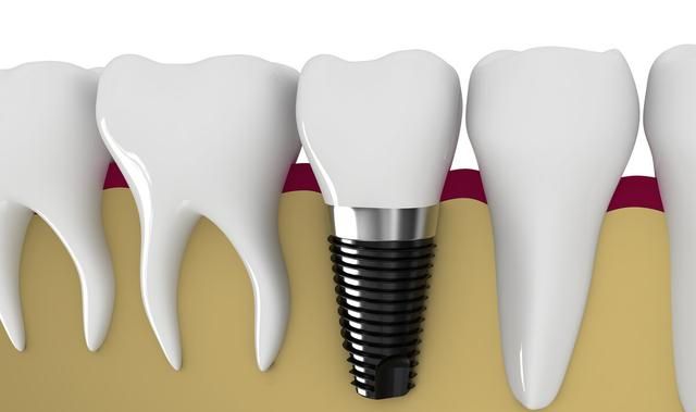 种植牙只有好没有坏吗？老牙医告诉你，种植牙的这些坏处不可避免