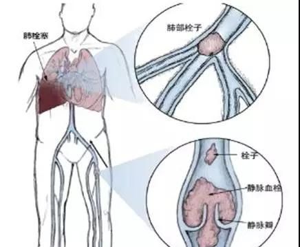 静脉血栓好治疗吗图1