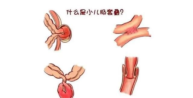 “世事无常，大肠包小肠”：肠套叠治疗切记这一黄金时间期！