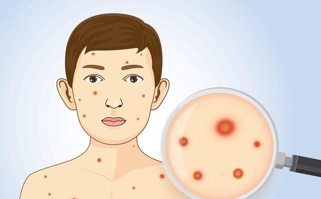 水痘真的具有传染性吗？传染途径比较广泛，得及时防范