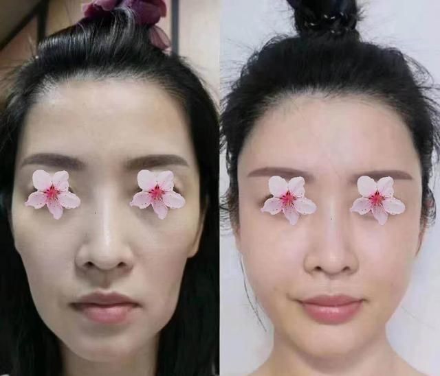 怎么填充太阳穴才能避免脸变大，有太阳穴凹陷的人来看看