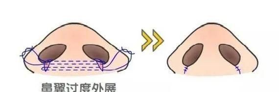 鼻翼缩小怎么缩？究竟缩小了哪里？