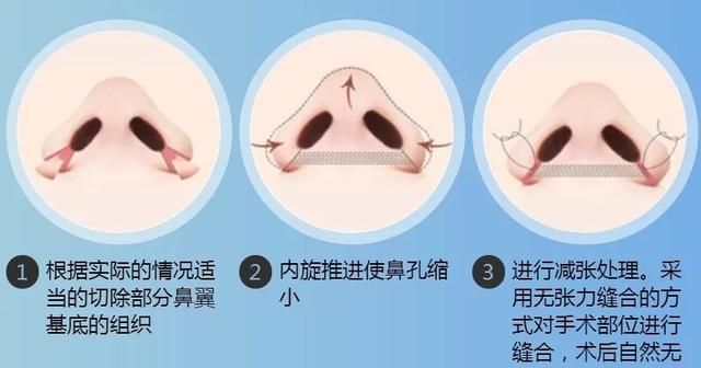 鼻翼缩小怎么缩？究竟缩小了哪里？