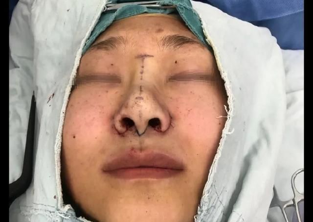鼻翼缩小怎么缩？究竟缩小了哪里？