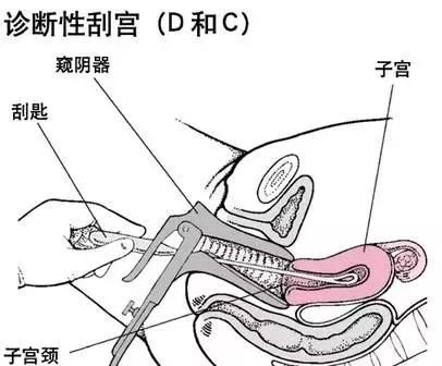 刮宫和人流是一样吗？