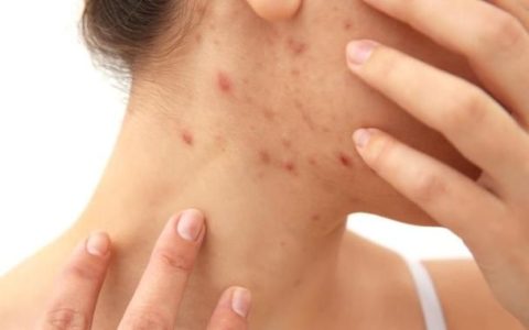 皮肤痘痘医生问答免费,长痘了生活中坚持2点可调理痘痘