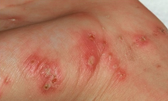 疥疮的临床表现及如何预防