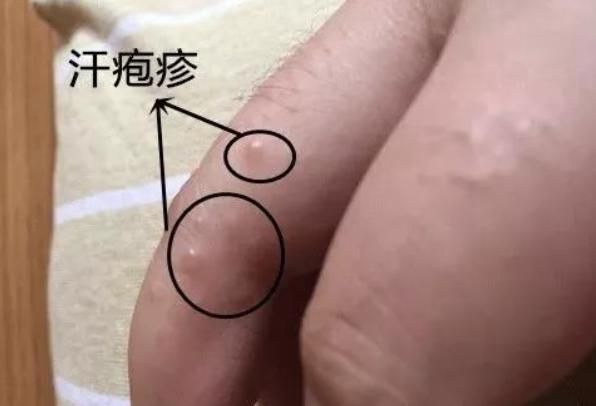 又痒又疼！到底为什么一到夏天就长磨人的"小水泡"？怎么治？→