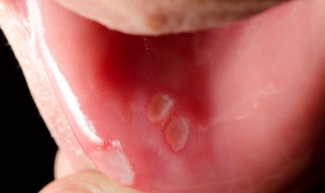 口腔溃疡用西瓜霜、维生素、溃疡贴，真的管用吗？