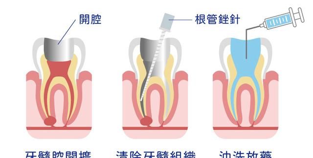 蛀牙痛怎么办？