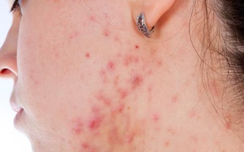 痤疮反复发作怎么治疗