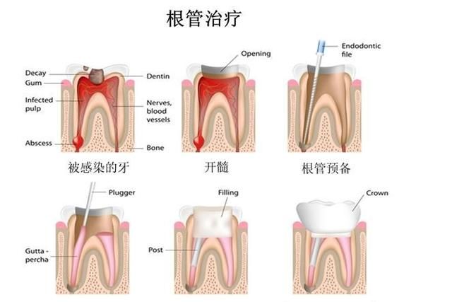 根管治疗完了会痛吗(根管治疗打牙桩痛吗)图1